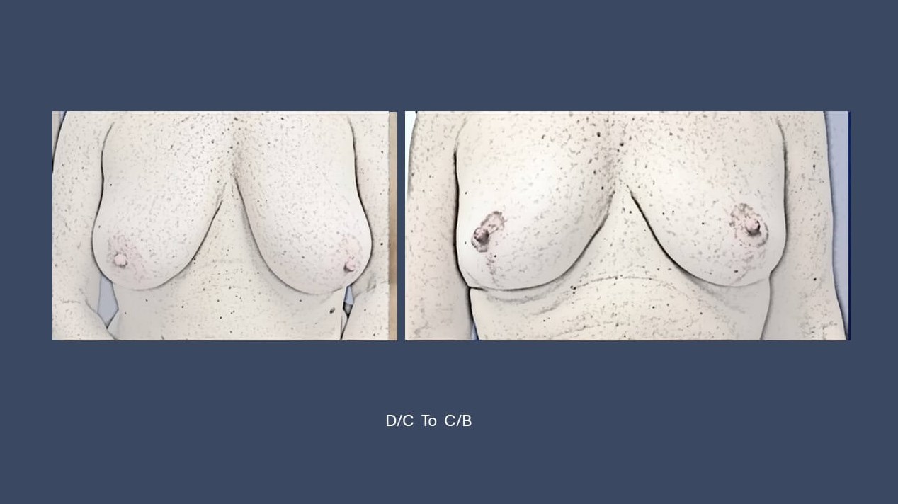 Dr Suzman Breast Reduction bef